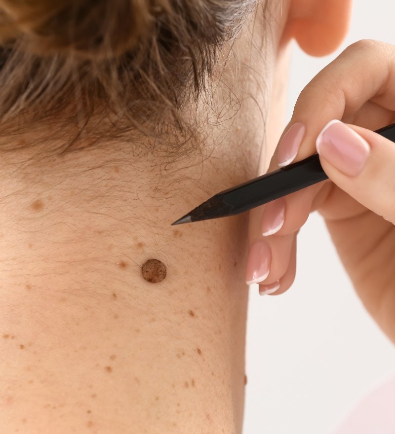 Mole Removal in Kaithal