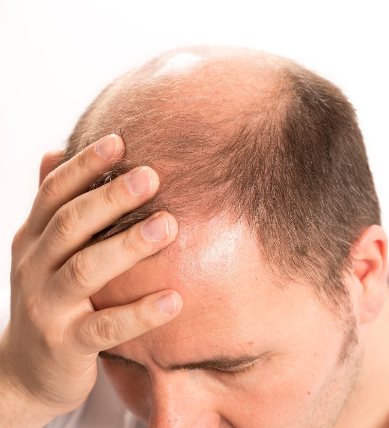 Alopecia Androgenetica Treatment in Kaithal