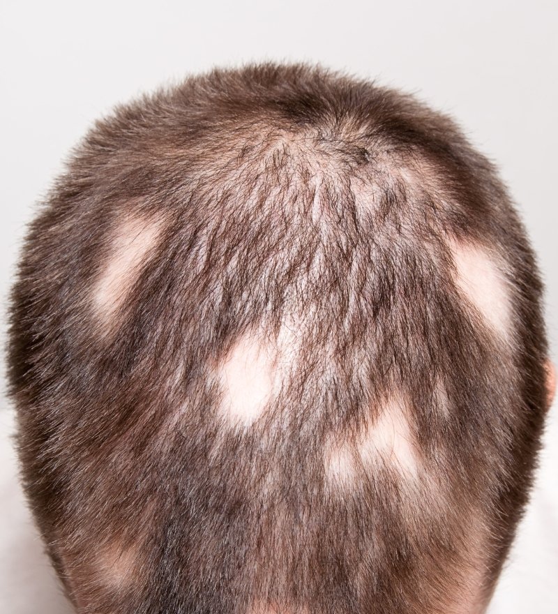 Alopecia Areata Treatment in Kaithal