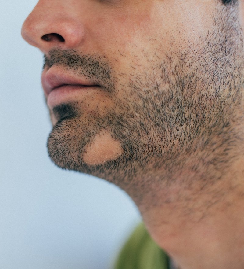Alopecia Barbae Treatment in Kaithal