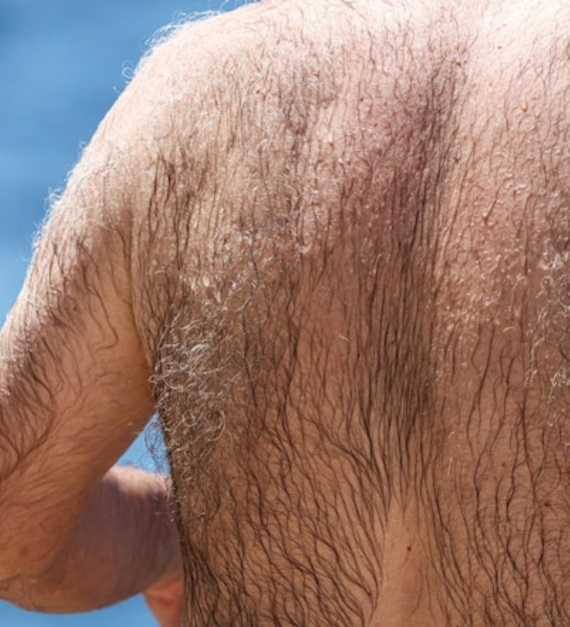 Hypertrichosis Treatment in Kaithal