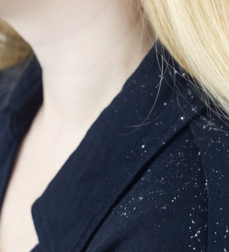 Pityriasis Capitis Treatment in Kaithal