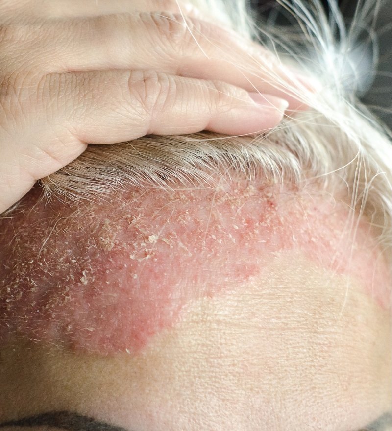 Seborrheic Dermatitis Treatment in Kaithal