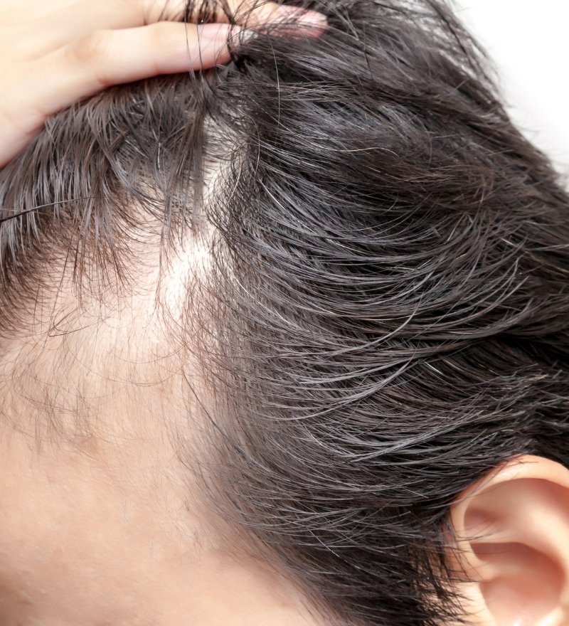 Traction Alopecia Treatment in Kaithal